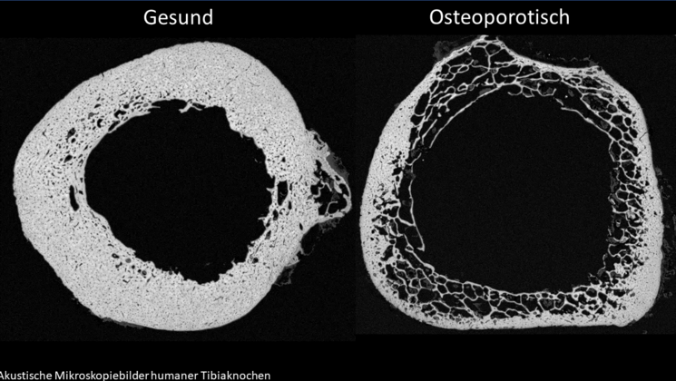 Rechts im Bild ist die Ultraschallaufnahme eines gesunden Knochen, rechts das Bild eines osteoporotischer Knochen.